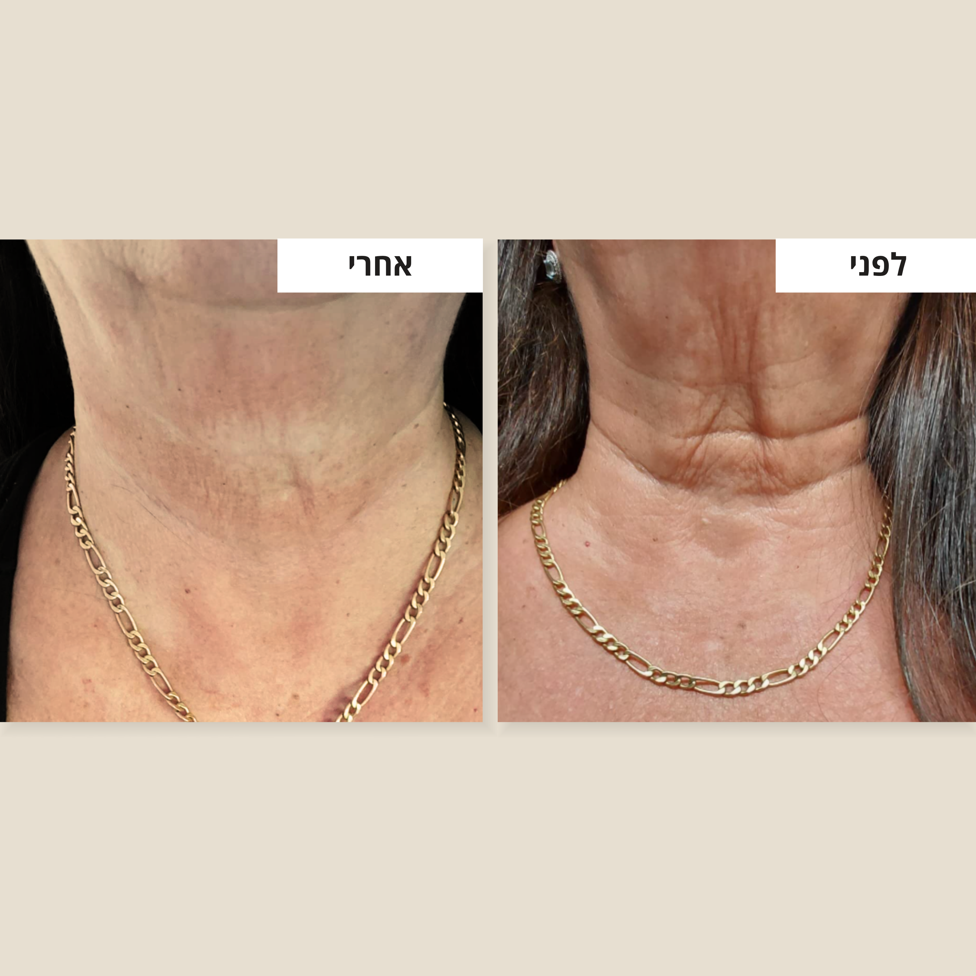 קרם למיצוק הצוואר