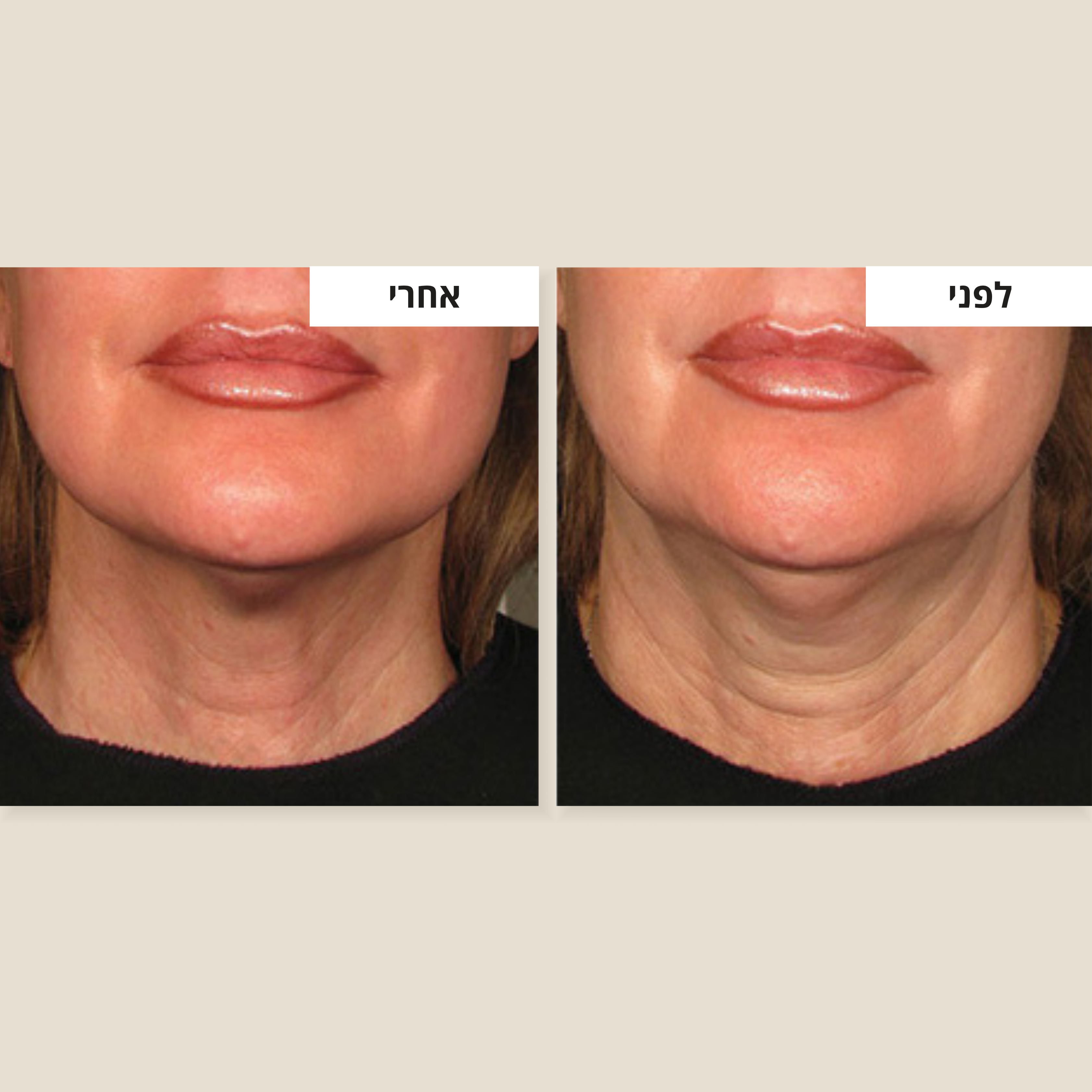 קרם למיצוק הצוואר